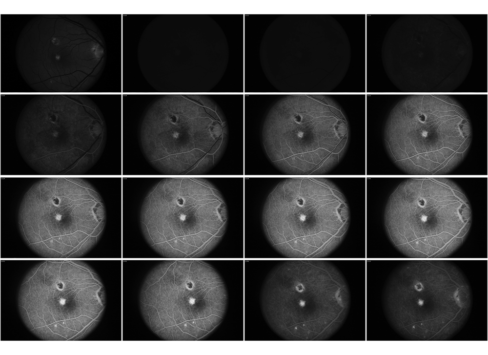 Series of time lapse photos of a Fluorescein Angiogram of right eye