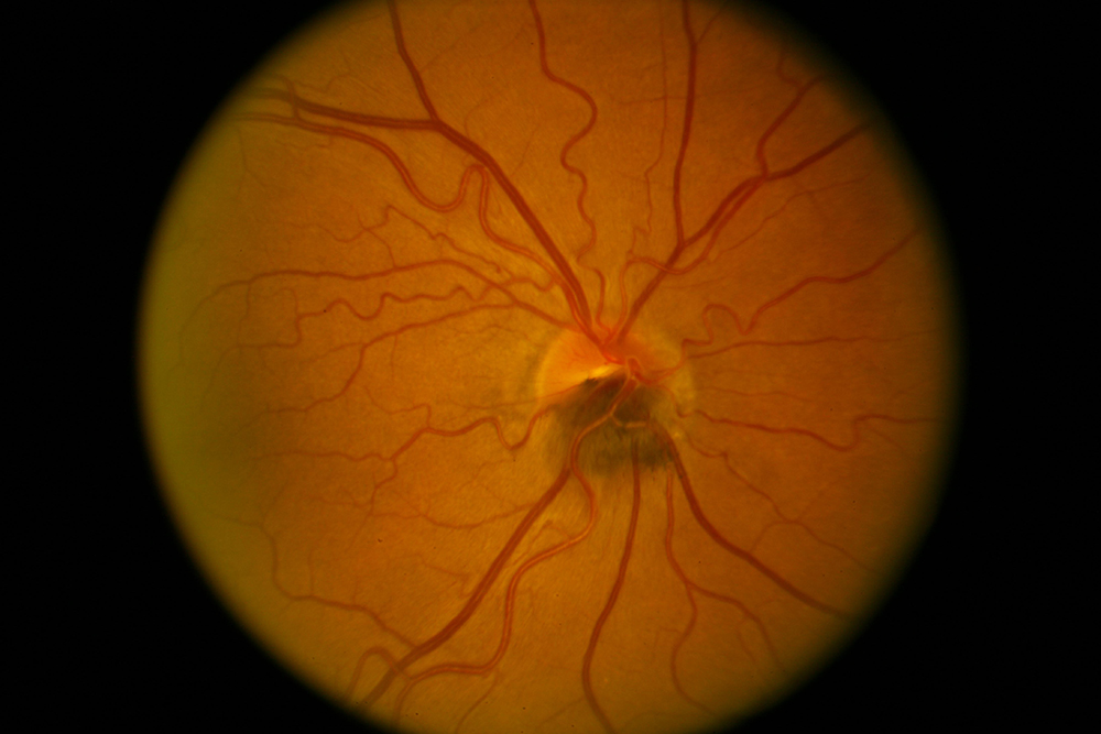 A microscopic image of a nevus on an optic nerve of the right eye 